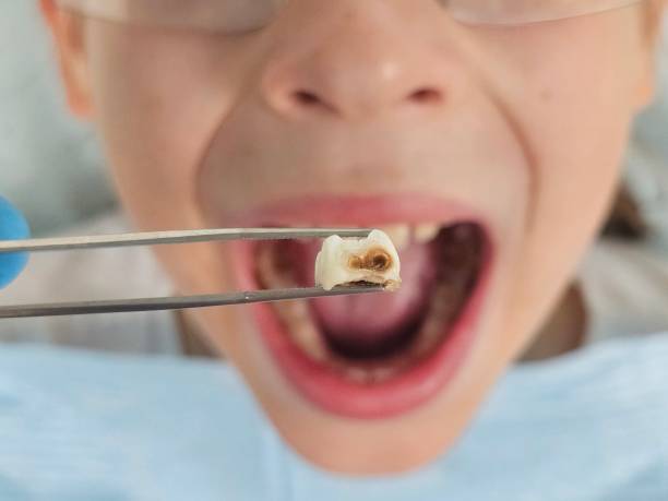 Best Emergency Tooth Extraction in Lincoln Rk, PA
